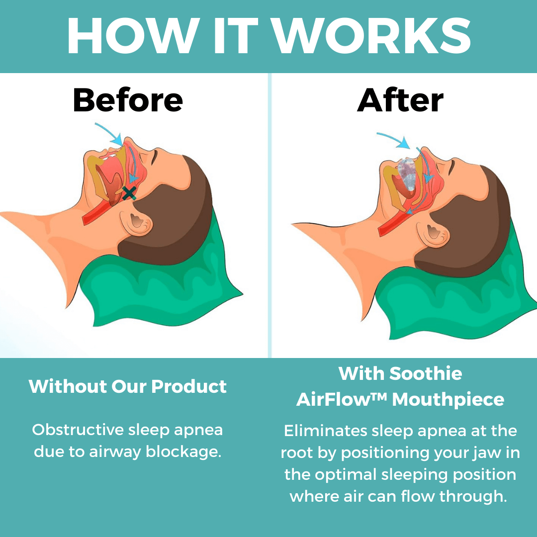 Airflow Anti-Snore Mouthpiece – Soothie