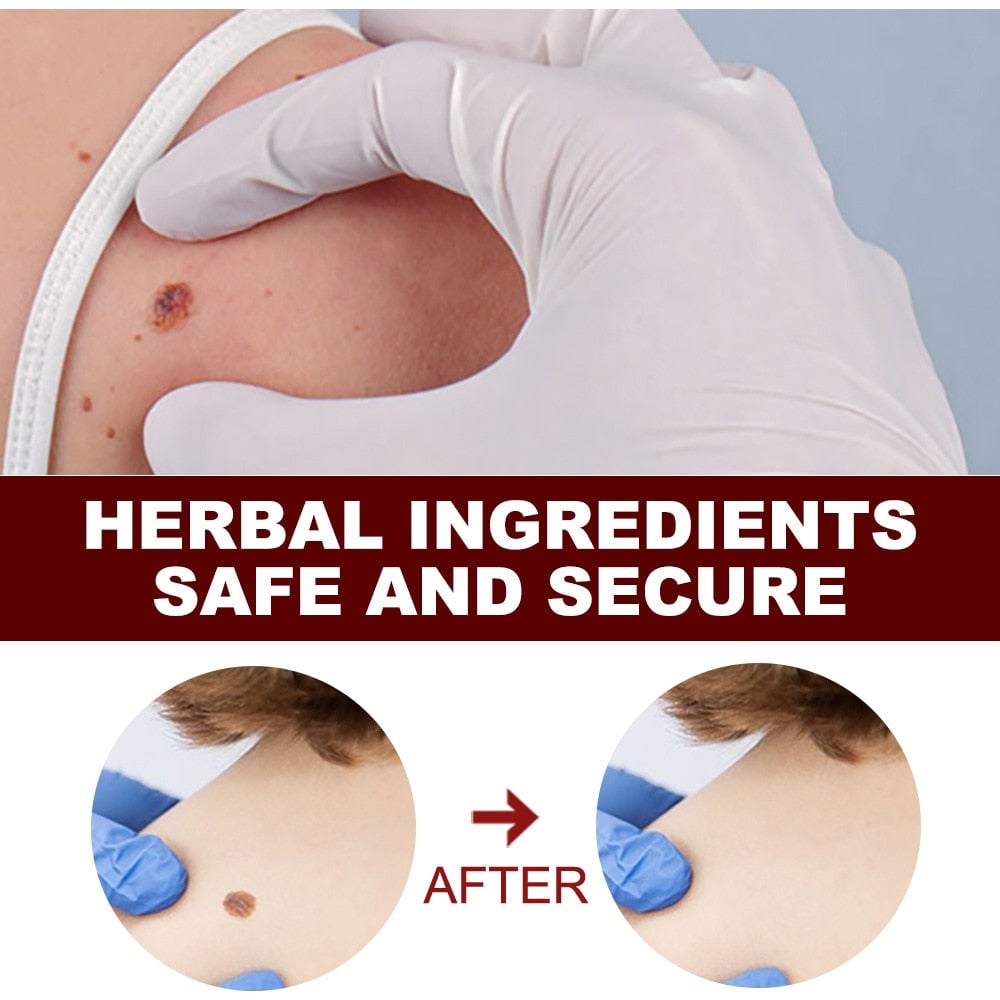 Wipeoff Tags & Moles Remover