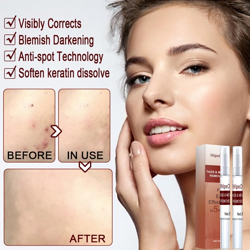 Wipeoff Tags & Moles Remover
