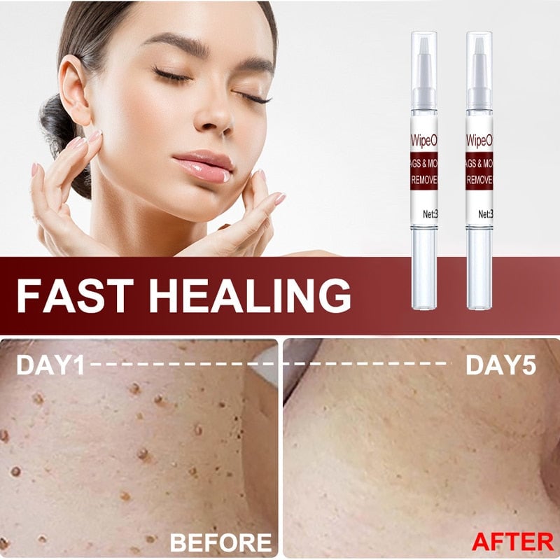 Wipeoff Tags & Moles Remover